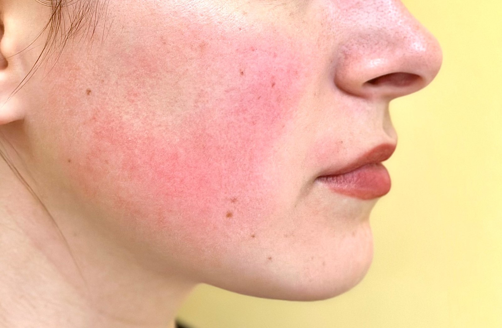 ROSACEA