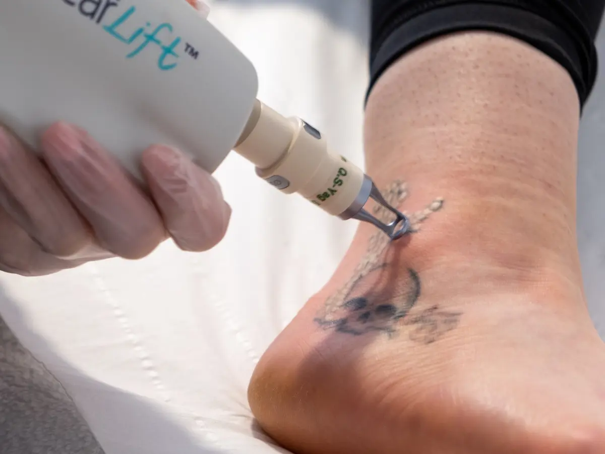 Tattoo removal
