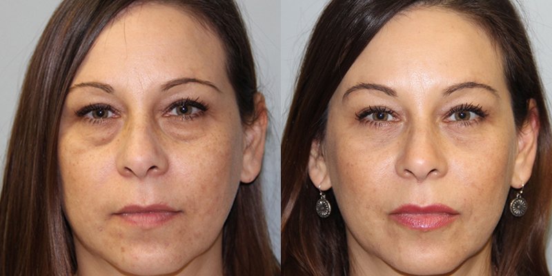 Upper and Lower Lid Resurfacing Treatments