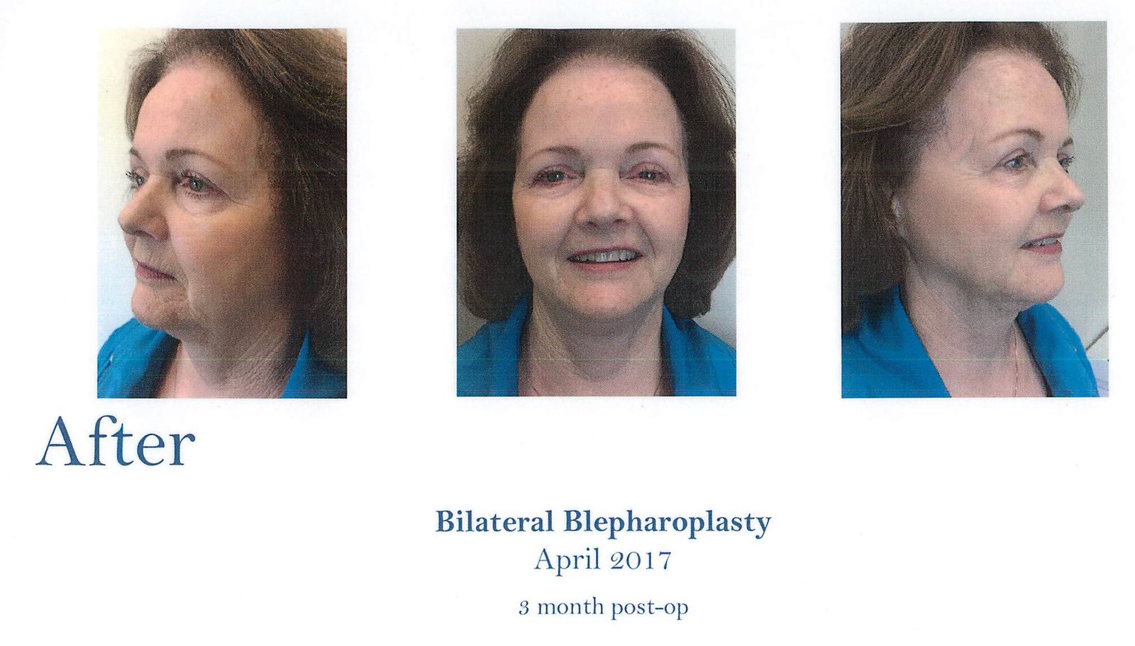 Blepharoplasty Surgery